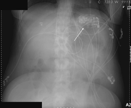 Fig. 1.  Abdominal X-ray from the patient's third overdose episode, taken approximately 3.5 h after ingestion and displaying numerous radio-opaque capsules in the stomach (arrow).