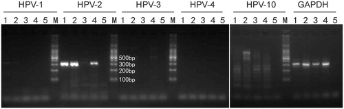 Figure 2. DNA was extracted from the scrapes of a lesion on the sole of her right foot. DNA segments specific for HPV type 2. It was identified by PCR which included HPV type 1, 2, 3, 4, 10 specific primers. The electrophoresis strip 1 represents the target lesion before treatment. Strip 2 represents the target lesion which was not noticeably improved after 2 months of treatment. Strip 3 represents the target lesion when all lesions were noticeably improved. Strip 4 represents the lesions except the target lesion when all lesions were noticeably improved. Strip 5 represents H2O.