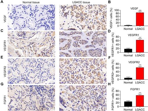 Figure 1 Neovascularization related proteins are highly expressed in LGACC tissues. VEGF (A), VEGFR1 (C), VEGFR2 (E), and FGFR1 (G) expression in LGACC and normal tissues detected by immunohistochemistry, and the related statistical analysis (B, D, F and H). ***p < 0.001. n=5.