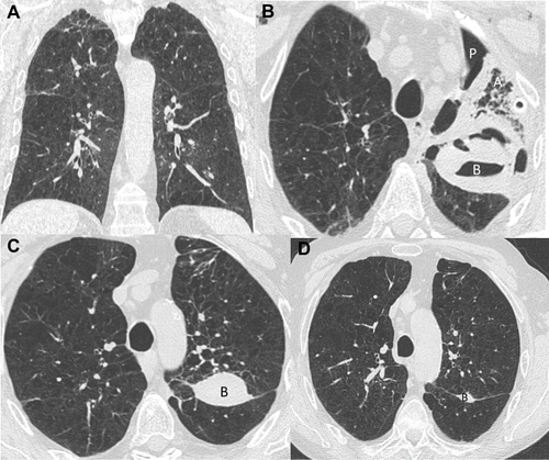 Figure 6 Chest CT evolution (patient 6). (A) Baseline chest CT which is characterized by homogeneous emphysema. (B) Chest CT performed 12 days after valves insertion in the left upper lobe (LUL). We can see occurrence of partial atelectasis (A), pneumothorax (P), chest tube drainage and the presence of a bulla (B) in left fissure with air–liquid level. (C) Chest CT performed 82 days after valves insertion (7 days after valves removal for post-obstructive pneumonia) which is characterized by the loss of the LUL atelectasis and a persistent bulla (B) completely filled with liquid in the left fissure. (D) Chest CT performed 262 days after valves insertion (6 months after valves removal for post-obstructive pneumonia) showing a nearly complete resolution of the bulla (B).