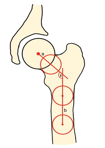 Figure 1. The neck–shaft angle (x) is composed of a and b; a = femoral neck axis, b = femoral shaft axis.