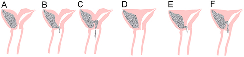 Figure 3 Anatomical illustrations of the utero-cervical-vaginal anatomy in Type III UGTOIRA syndrome (cervical obstruction).Partial bicorporeal septate uterus, septate cervix with unilateral obliterated cervical os, with one normal vagina, without communication (A), with a fistula in the cervical septum (B), with communication between both internal orifices of the cervix (C); complete septate uterus, septate cervix with ipsilateral obliterated cervical os, with one normal vagina, without communication (D), with a fistula in the cervical septum (E), with communication between both internal orifices of the cervix (F).