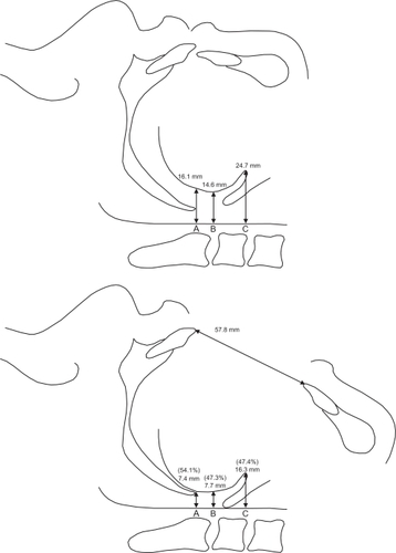 Figure 4 Changes in the upper airway formation induced by maximum opening of the mouth.