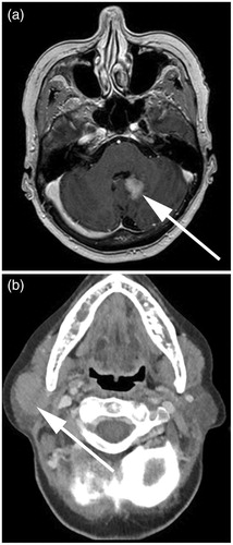 Figure 2. Radiological images of brain tumor (2015) and submandibular lymph node lesion (2016). (a) Brain tumor, located at the right frontal lobe, detected by T1 weighted MRI. (b) Submandibular lymph node lesion (left), detected by CT-scan.