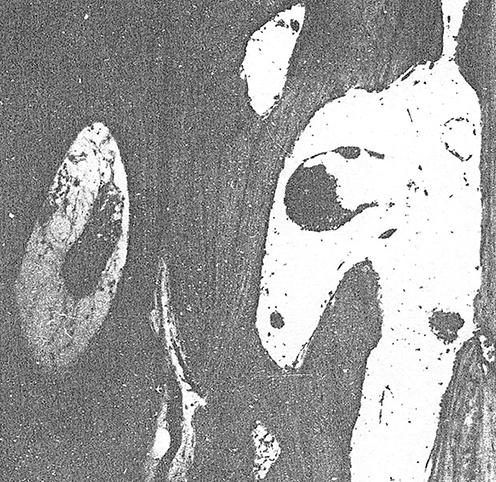 Figure 6 Microphotograph. Resorption of compact bone tissue. Full blood vessels. Haematoxylin and eosin staining. x80.