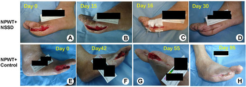 Figure 2 (A–D) A comparison of one patient in the negative-pressure wound therapy (NPWT) + non-invasive skin stretching device (NSSD) group before and after treatment. (A) Before enrollment, no obvious necrotic tissue on the wound after debridement; (B) after NPWT; (C) application of the adhesive NSSD; (D) wound healing. (E–H) A comparison of one patient in the NPWT + Control group before and after treatment; (E) before enrollment, no obvious necrotic tissue on the wound after debridement; (F) during the NPWT; (G) after the NPWT; (F) wound healing.