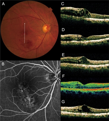 Figure 4 Recurrence of macular edema after grid photocoagulation combined with intravitreal bevacizumab (IVB) for recurrent macular edema associated with branch retinal vein occlusion. (A) A 65-year old woman had a visual disturbance in the right eye (0.6 OD) due to macular edema associated with branch retinal vein occlusion. (B) Fluorescein angiogram shows fluorescein leakage from the capillaries. (C–G), Vertical sectional images centered on the fovea with optical coherence tomography were obtained at the initial visit (C), at 1 month after initial IVB (D), just before the combined therapy (at baseline, E), at 1 month (F) and at 3 months (G) after the combined therapy. She had a recurrent cystoid space beneath the fovea after combination therapy (0.9 OD).