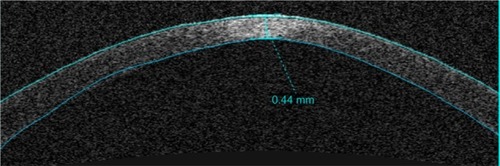 Figure 3 Anterior segment optical coherence tomography image of an eye with keratoconus, demonstrating central thinning of the cornea.