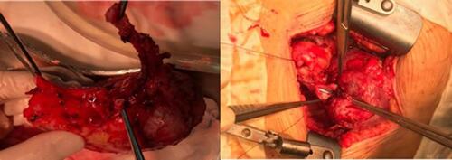 Figure 3 The image on the left depicts the right kidney after retroperitoneal nephrectomy. The diseased ureter can be seen at the top of the image. The right image shows the surgeons placing the right kidney into the left iliac fossa via a Gibson incision.