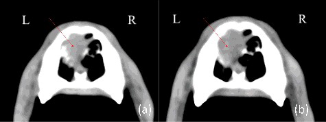 Figure 5. Pre-treatment and post-treatment CT images of case 3: (a) pre-treatment transverse; (b) post-treatment transverse. Arrows mark the tumour.