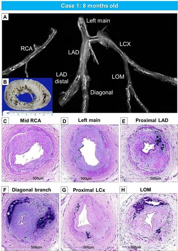 Figure 2 Gross, radiographic, and histologic images of the heart and coronary artery from a 8-months-old male with GACI. Radiographs of excised coronary arteries (CA) (A) demonstrate focal calcification of all four major branches [left main, left anterior descending (LAD), left circumflex (LCX), and right CA (RCA)] and smaller branches. (B) Mid-left and right ventricular slices of the heart show dilatation of the LV and subendocardial circumferential healed myocardial infarction, along with transmural scarring of the posterolateral wall of LV. (C–H). Hematoxylin and eosin-stained sections of the major coronary arteries and branch vessels demonstrating moderate to severe luminal narrowing with or without medial calcification (A, B, E–H) are reproduced with permission from Federici et alCitation58.