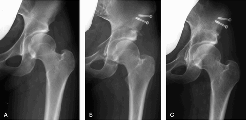 Figure 4. Medialization type. (A) A 24‐year‐old female with Tönnis classification grade 1 OA before CPO in 2006. The CE angle and ARO are 5° and 22°, respectively. (B) Immediately after surgery, showing a modified pubic osteotomy with a 30° inclination from the horizontal line in CPO. (C) Bony union at the osteotomy sites is observed at 4 months after CPO. The CE angle and ARO are 44° and ‐7°, respectively. Since the ratio of lateralization of the femoral head is 0.73, this hip is classified as the medialization type.