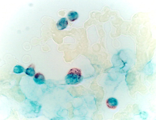 Figure 3.  Histidine decarboxylase activity in bone marrow smear with 30% plasma cell infiltration rate. Plasma cells are shown to be HDC positive. Immunohistochemical staining.