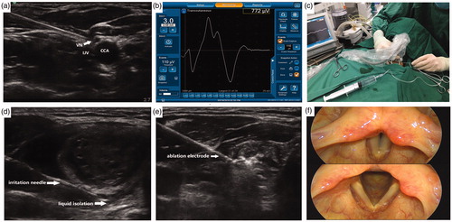 Figure 3. Procedure of neural monitoring during radiofrequency ablation of thyroid nodules (a) An ultrasoundguided puncture with the nerve-stimulation needle was performed between the lateral common carotid artery (CCA) and the medial internal jugular vein (IJV) and the vagus nerve (VN) was identified (b) EMG amplitudes were measured by NIM® Nerve Monitoring System 3⋅0 (Medtronic) (c) The needle was used to inject saline and continuously detect the recurrent laryngeal nerve with 3.0 mA current (d) A ‘liquid isolation zone’ was formed with a width of approximately 5 mm on the dorsal side of thyroid gland (e) The radiofrequency electrodes were placed into the nodule, and ablation was performed (f) After ablation, a final vagus electromyography (V2) was induced using 3.0 mA stimulus current and fibro laryngoscopies were performed on the first day following the procedure.