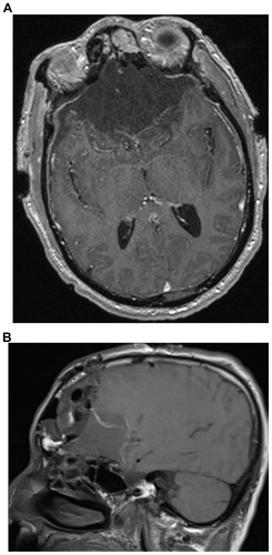 Figure 3 Contrast-enhanced T1 axial (A) and sagittal (B) magnetic resonance image 1 week after bilateral frontal lobe craniotomy showing an extensive fluid and extraaxial pneumocephalus in the surgical bed without evidence of residual tumor.