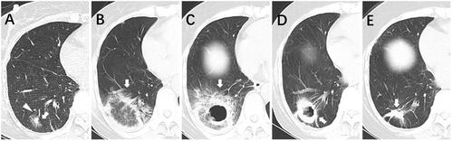 Figure 3. A 59-year-old woman with lung cancer in the right lower lobe of the lung was treated with percutaneous microwave ablation (MWA). (A) subsolid GGO (white arrowhead) located in the lower right lobe of the lung, in contact with a large bronchus (white triangle). (B) A CT image obtained 24 h after MWA showing a larger fried-egg sign (white arrowhead) on the ablation zone. (C) A CT image obtained four days after MWA shows an enlarging cavitation (white arrowhead) with a maximum diameter of 58 mm. (D) A CT image obtained 3 months after MWA showing a shrinking cavitation (white arrowhead). (E) A CT image obtained 12 months after MWA showing the disappearance of cavitation and shrinking as a scar (white arrowhead).