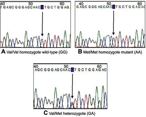 Figure 1 Sequencing results of the heterozygote Val92Met genotype of the MC1R gene polymorphisms.