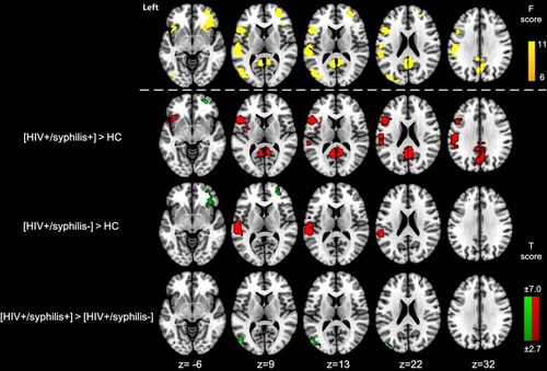 Figure 1 DC differences among HIV+/syphilis+, HIV+/syphilis- and HC groups.Notes: F-test of ANOVA showed DC differences mainly located in bilateral frontal cortex, left occipital cortex, and bilateral inferior parietal lobule (yellow). HIV+/syphilis+ showed decreased DC in the right frontal cortex and increased DC in the bilateral inferior parietal cortex and left occipital cortex. HIV+/syphilis- showed decreased DC in the right frontal cortex and increased DC in the left inferior parietal cortex. Compared with HIV+/syphilis-, HIV+/syphilis+ displayed decreased DC in the left occipital cortex. (P<0.005, cluster number = 249, α = 0.05, corrected). Increased DC was shown in red, while decreased DC was shown in green.Abbreviations: ANOVA, analysis of variance; DC, functional connectivity density; HIV+/syphilis+, HIV patients with syphilis coinfection; HIV+/syphilis-, HIV patients without syphilis coinfection; HC, healthy controls.