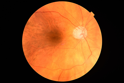 Figure 1 Funduscopic image of glaucomatous optic disc in 74-year female (right eye).
