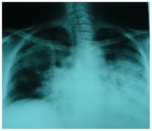 Figure 1 Chest X-ray upon admission.