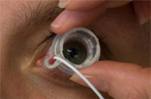 Figure 2 Ocular iontophoresis application. The photo shows the iontophoretic applicator placement on the eye.