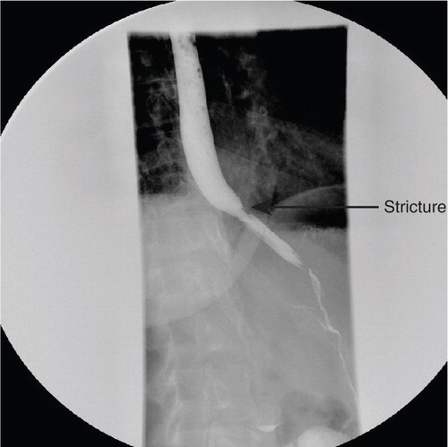 Fig. 4 Barium swallow prior to discharge showing interval healing of dissection and a stricture at the site proximal to prior dissection.