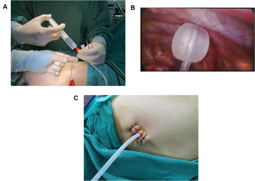 Figure 1 (A–C) The 18F silicone Foley catheter was inserted into the thoracic cavity and filled with 15 mL sterile water to be fixed on the Parietal pleura, no need for suture to fix.