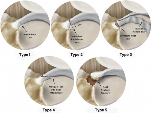 Figure 1. Illustrations of the meniscal root tear classification system in 5 different groups based on tear morphology. For consistency, all meniscal tears are shown as medial meniscal posterior root tears in this illustration. The classification of 5 tear patterns was based on morphology: partial stable root tear (type 1), complete radial tear within 9 mm of the bony root attachment (type 2), bucket-handle tear with complete root detachment (type 3), complex oblique or longitudinal tear with complete root detachment (type 4), and bony avulsion fracture of the root attachment (type 5). Reprinted with permission from LaPrade et al. (Citation2015b).