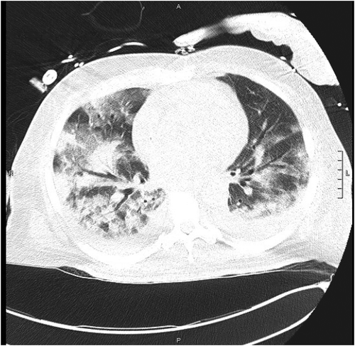 Figure 3. Axial section CT non-enhanced (lung window), section 55, obtained in the emergency department demonstrating further ground glass infiltration. L = Left side, A = anterior, P = posterior, scale = 1cm