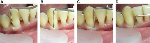 Figure 7 “Walking” probing of the periodontal pocket using a Naber periodontal probe. Distal buccal point (A), middle buccal point (B), mesial buccal point (C), all measurements are 2 mm probing depth. (D) Narrow and deep 8 mm periodontal pocket on the mesial tooth surface.