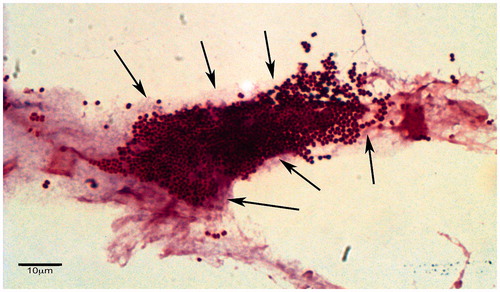 Figure 9. Imaging methods for biofilms – Gram stain. Gram-stained section of wound tissue debridement samples collected from patients with chronic diabetic foot wounds. Presumptive bacterial microcolonies and biofilm matrix have been indicated by arrows (Oates et al., Citation2014). © Andrew McBain. Reuse not permitted.