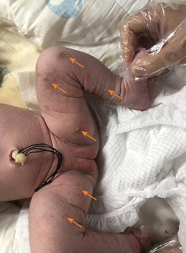 Figure 1 Typical yellow blisters on the infant’s skin (see arrow).