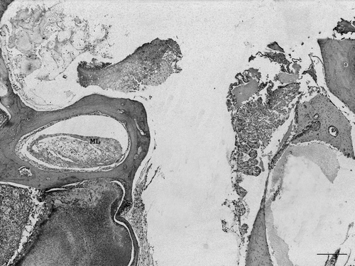 Figure 5.  Magnified view of Figure 1. Semicircular canal with moderate heterophilic inflammation and destruction of the membranous labyrinth (ML). A severe exudate surrounds the canal with destruction of bony labyrinth (also shown in Figure 2). Remnants of cochlear sensorial and vascular epithelium can be seen on the right. Haematoxylin and eosin. Bar = 200 µm.