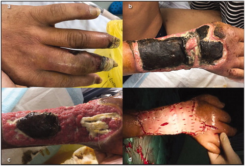 Figure 4. (a) Preablation fingertip necrosis. (b) Seven days later the skin necrosis involved the entire forearm. (c–d) Debridement plus autologous skin transplantation.