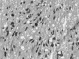 Figure 2 High-grade glioma showing pleomorphic tumor cells and increased cellularity. H&E, × 400.
