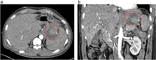 Figure 2. Computed tomography angiogram of abdomen (a) transverse view, (b) coronal view both showing hyper-dense lesion surrounded with peripancreatic fluid collection at the hilum of the spleen (red circle). The arrow shows the branch of the splenic artery feeding pseudoaneurysm.