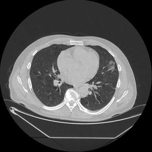 Figure 1. Transverse image obtained through left lung lingula superior demonstrates areas with ground-glass attenuation.