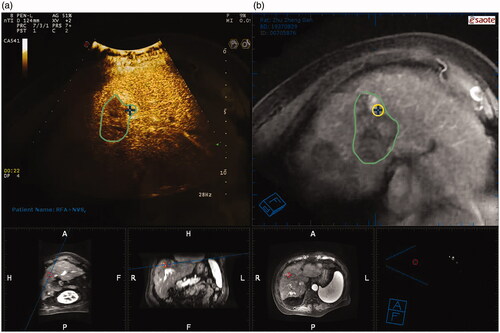 Figure 2. Virtual navigation-guided radiofrequency ablation. The green boundary area represents the entire post-TACE area it is difficult to identify the residual viable HCC area using CEUS alone. (a) The fusion image of CEUS and CEMRI showed that the residual viable HCC of both were well matched; (b) The cross marker is an active part of HCC in MRI image, indicating the incomplete deposition of lipiodol.