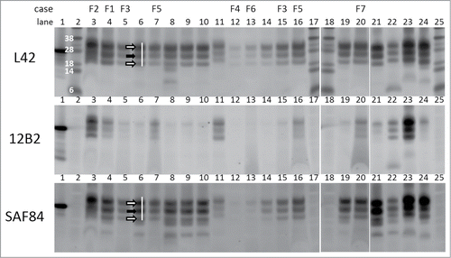 Figure 1. Triplex-WB analysis picture of study cases together with some reference samples. Selection of samples analyzed include all study cases numbers F1–F7. All lanes contain ovine samples except lanes 10 and 22, respectively caprine CH1641 Cgt and bovine BSE-H. Lanes 6, 8, 9, 14, 19, and 21: ovine CH1641 samples C8, C9, C1, C7, C3, and C6; lane 11 experimental scrapie J1; lanes 23 and 24 respectively ovine classical scrapie N18 and BSE B4 (details of case codes in Table 1). In the triplex‑WBs a mix of the 3 antibodies L42, 12B2 and SAF84 was applied. As an example for the glycoprofile estimation, the white bar shows the typical triple band (3 arrows) area in the L42 and SAF84 channels, thus neglecting the 2 lower bands that are visible in CH1641 samples. The migration position of mono‑glycosylated PrPres fraction (at ± 24 kDa) is indicated with a black arrow, the di-glycosylated and non-glycosylated fractions (white arrows) migrate respectively above and below the 24kDa band in this triplet region. Marker proteins used are: rec‑ovPrP in lane 1; molecular mass markers in lanes 2, 17, 18 and 25 with in lane 2 the molecular masses in kDa. TE applied per lane: 0.5 mg in lanes 3, 21–24, 0.8 mg in lane 7, 1 mg in lanes 4–6, 8–16, 19–20. See Methods section for antibody details and fluorescence detection.