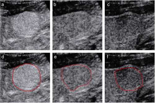 Figure 2 An example of segmentation of three-phase images from a 58-year-old man. The figures above respectively show representative images of the arterial phase (a), the portal venous phase (b), and the delayed phase (c), along with their corresponding regions of interest (ROI) (d-f). The red curve represented the tumor contour.