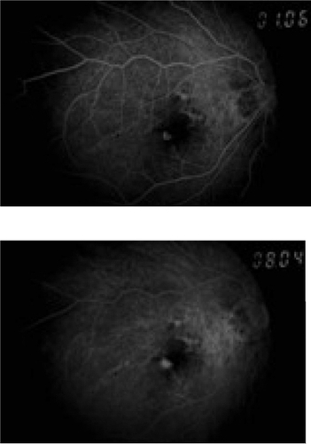 Figure 2 The FFA of the right eye showed the presence of choroidal neovascularisation with the evidence of hyperfluoresence area at the fovea which increased in intensity and size throughout the phase.