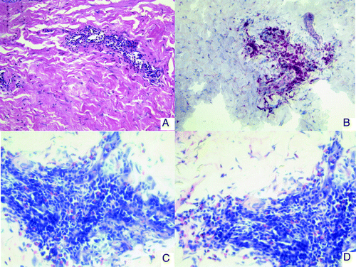 Figure 2. Immunohistology of skin biopsies from DTH challenge sites (patient no.3). (A) HE staining: a perivascular infiltrate is observed in the dermis. (B) CD3 staining. The infiltrate consists mainly of CD3 positive T-lymphocytes. (C and D) Giemsa staining showing eosinophilic infiltration