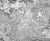 Fig. 3 Detail of a multinucleate pleomorphic histiofibroblast. The abundant cytoplasm contains a prominent branching RER, a Golgi complex, and some scattered lysosomes and lipid droplets. EM, × 15,400.