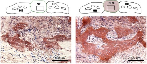 Figure 5 Histological analysis of the effect of BMP-7 nanoreservoirs in vivo on bone tissue regeneration.Notes: Histological analysis of in vivo bone induction onto functionalized PCL scaffold (NR4) compared to bare PCL (NF) scaffold after 30 days of calvaria implantation in mice. Mallory coloration was used in order to identify mineralized extracellular matrix (pink) and cell nuclei (blue). The square area in the drawn scheme represents the histological section inside the mouse calvaria defects.Abbreviations: HB, host bone; NF, not functionalized; NR4, functionalized with (chitosan/BMP-7)4 nanocontainers; PCL, poly(ε-caprolactone).