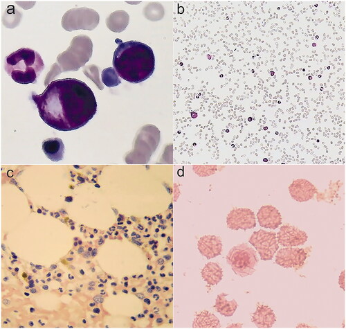 Figure 3. Bone marrow smears. (a,b) Cytologic examination in December, 2018: bone marrow was active proliferation, granulocyte was 49%, erythroid was 45%, and granulocyte: erythroid was 1.1:1. (c) Pathological examination: no pathological cells. (d) Iron stain: extracellular iron +, intracellular iron 55%, no ring sideroblasts.
