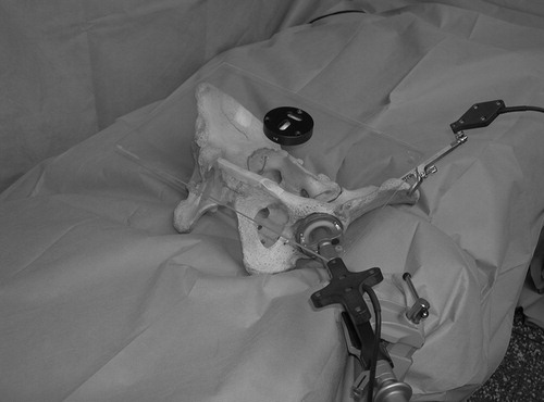 Figure 3. The setup for the error analysis is shown. The cadaveric pelvis is fixed on a vacuum mattress with the APP in horizontal orientation. A tracked cup impactor is rigidly fixed to the table in a position of 15° of version and 40° of cup abduction relative to the APP. Different predefined scenarios for maldefinition of the iliac spines and the mid-pubic point were rehearsed, and the resulting cup orientation angles were displayed by the navigation system.