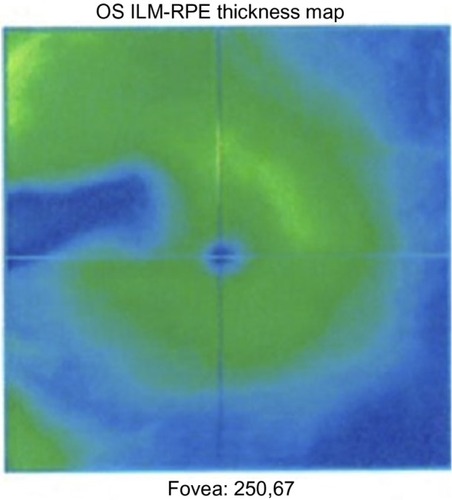 Figure 3 OCT scan of the macula showing loss of retinal pigment epithelium 14 weeks after the occlusion.