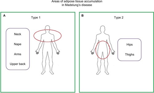 Figure 1 Madelung’s disease: division based on the area of adipose tissue accumulation.