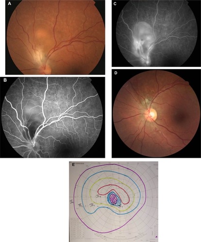 Figure 6 (A) Fundus photograph of the left eye of a patient with ocular toxoplasmosis shows a juxtapapillary active area of retinochoroiditis adjacent to a pigmented scar with associated serous retinal detachment. (B) Early-phase fluorescein angiogram shows hypofluorescence of both active and old foci. (C) Late-phase fluorescein angiogram shows peripheral hyperfluorescence and persistent central hypofluorescence of the active focus of retinochoroiditis with late pooling of dye in the subretinal space and optic disc hyperfluorescence. (D) Fundus photograph 6 months later shows a small atrophic retinochoroidal scar that replaced the active toxoplasmic lesion with a localized defect of the retinal nerve fiber layer as wedge-shaped area running toward the optic disc. (E) Goldmann perimetry shows a persistent scotoma.