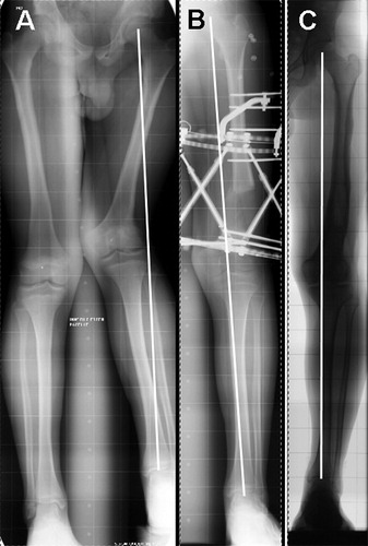 Figure 1. A 14-year-old boy with shortening and valgus deformity after physeal injury at the left distal femoral physis. Long standing radiograph initially (panel A), when the lengthening and axis correction were completed (B), and 12 months after frame removal (C).